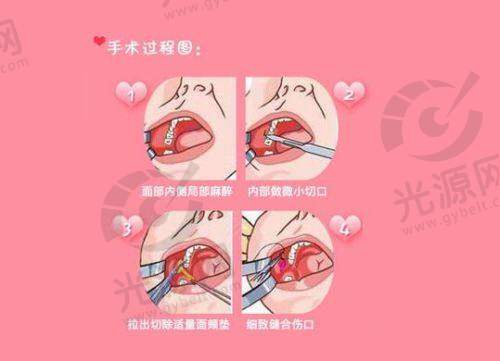 化学剥脱祛斑项目